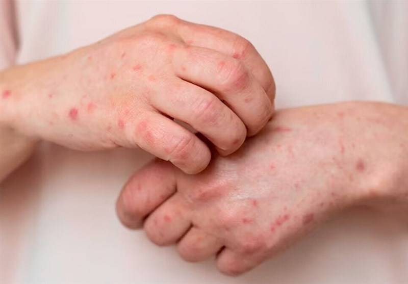 هشدار درباره شیوع آبله مرغان؛ ضرورت آگاهی و پیشگیری