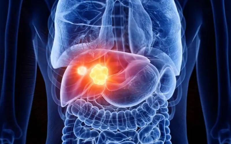 یکی از مرگبارترین سرطان‌های دنیا با سه راهکار ساده قابل پیشگیری است